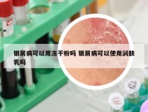 银屑病可以用冻干粉吗 银屑病可以使用润肤乳吗