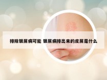 排除银屑病可能 银屑病排出来的皮屑是什么