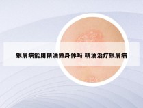 银屑病能用精油做身体吗 精油治疗银屑病