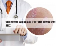 银屑病照光后发红是否正常 银屑病照光之后发红