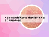 一感冒银屑病复发怎么办 感冒引起的银屑病治疗周期多长时间