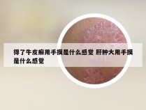 得了牛皮癣用手摸是什么感觉 肝肿大用手摸是什么感觉