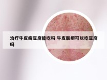 治疗牛皮癣豆腐能吃吗 牛皮肤癣可以吃豆腐吗