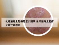 化疗后身上起癣是怎么回事 化疗后身上起疹子是什么原因