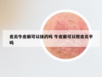 皮炎牛皮癣可以抹药吗 牛皮廨可以擦皮炎平吗