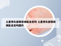 儿童得头部银屑病能自愈吗 儿童得头部银屑病能自愈吗图片