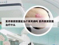 紫丹银屑胶囊能治疗银屑病吗 紫丹银屑胶囊治疗什么