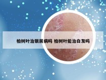 柏树叶治银屑病吗 柏树叶能治白发吗