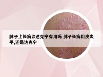 脖子上长癣涂达克宁有用吗 脖子长癣用皮炎平,还是达克宁