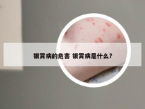 银霄病的危害 银霄病是什么?