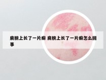 肩膀上长了一片癣 肩膀上长了一片癣怎么回事