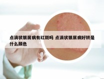 点滴状银屑病有红斑吗 点滴状银屑病好转是什么颜色