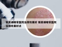 银屑病哪家医院治得效果好 银屑病哪家医院治得效果好点