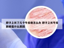 脖子上长了几个牛皮癣怎么办 脖子上长牛皮肤癣是什么原因