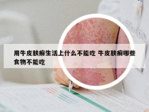 用牛皮肤癣生活上什么不能吃 牛皮肤癣哪些食物不能吃