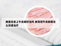 刚查出患上牛皮癣好治吗 刚发现牛皮肤癣怎么快速治疗