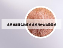 皮肤癣用什么洗澡好 皮癣用什么洗澡最好