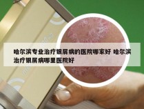 哈尔滨专业治疗银屑病的医院哪家好 哈尔滨治疗银屑病哪里医院好