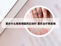 重庆什么银屑病医院比较好 重庆治疗银屑病