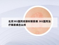 北京301医院皮肤科银屑病 301医院治疗银屑病怎么样