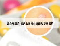 舌白斑图片 舌头上出现白斑图片早期图片