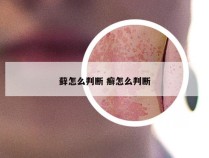 藓怎么判断 癣怎么判断