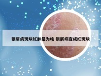 银屑病斑块红肿是为啥 银屑病变成红斑块