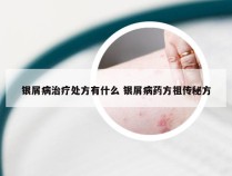 银屑病治疗处方有什么 银屑病药方祖传秘方