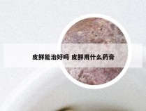 皮鲜能治好吗 皮鲜用什么药膏