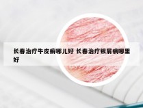 长春治疗牛皮癣哪儿好 长春治疗银屑病哪里好