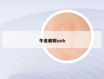 牛皮癣照uvb