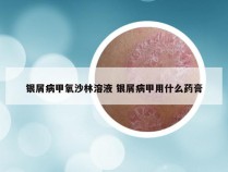 银屑病甲氧沙林溶液 银屑病甲用什么药膏