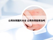 口周白斑图片大全 口周白斑能根治吗