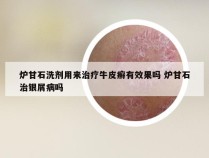 炉甘石洗剂用来治疗牛皮癣有效果吗 炉甘石治银屑病吗