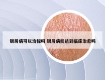 银屑病可以治标吗 银屑病能达到临床治愈吗