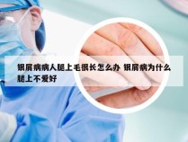 银屑病病人腿上毛很长怎么办 银屑病为什么腿上不爱好