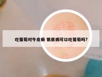 吃葡萄对牛皮癣 银屑病可以吃葡萄吗?