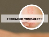 皮肤癣怎么能治疗 皮肤癣怎么能治疗好