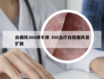 白癜风308疼不疼 308治疗白斑癜风易扩散