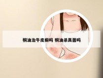 桐油治牛皮癣吗 桐油杀真菌吗