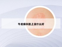 牛皮癣长脸上涂什么好