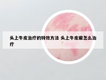 头上牛皮治疗的特效方法 头上牛皮廨怎么治疗