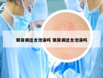 银屑病适合泡澡吗 银屑病适合泡澡吗