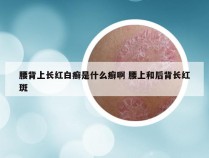 腰背上长红白癣是什么癣啊 腰上和后背长红斑