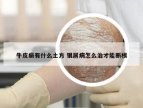 牛皮癣有什么土方 银屑病怎么治才能断根