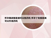 怀孕期间银屑病可以擦药吗 怀孕了有银屑病可以外用药吗