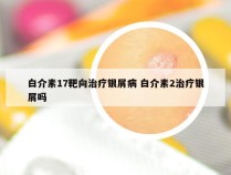 白介素17靶向治疗银屑病 白介素2治疗银屑吗