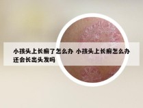 小孩头上长癣了怎么办 小孩头上长癣怎么办还会长出头发吗