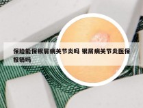 保险能保银屑病关节炎吗 银屑病关节炎医保报销吗