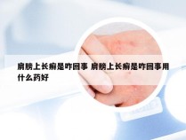 肩膀上长癣是咋回事 肩膀上长癣是咋回事用什么药好